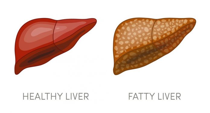 natural help for non-alcoholic fatty liver disease nafld natural help for non-alcoholic fatty liver disease nafld